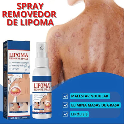 Spray Lipoma – Reduce Bultos Sin Bisturí y Desde Casa