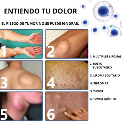 Spray Lipoma – Reduce Bultos Sin Bisturí y Desde Casa